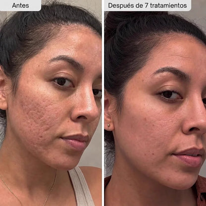 Potenciador de Piel con Micro-Infusión de Péptidos
