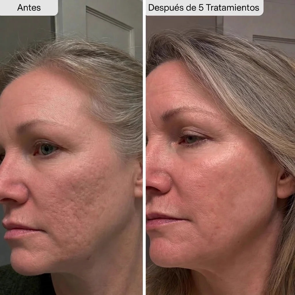 Potenciador de Piel con Micro-Infusión de Péptidos