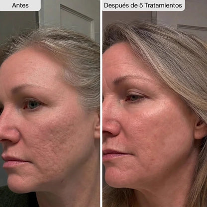 Potenciador de Piel con Micro-Infusión de Péptidos