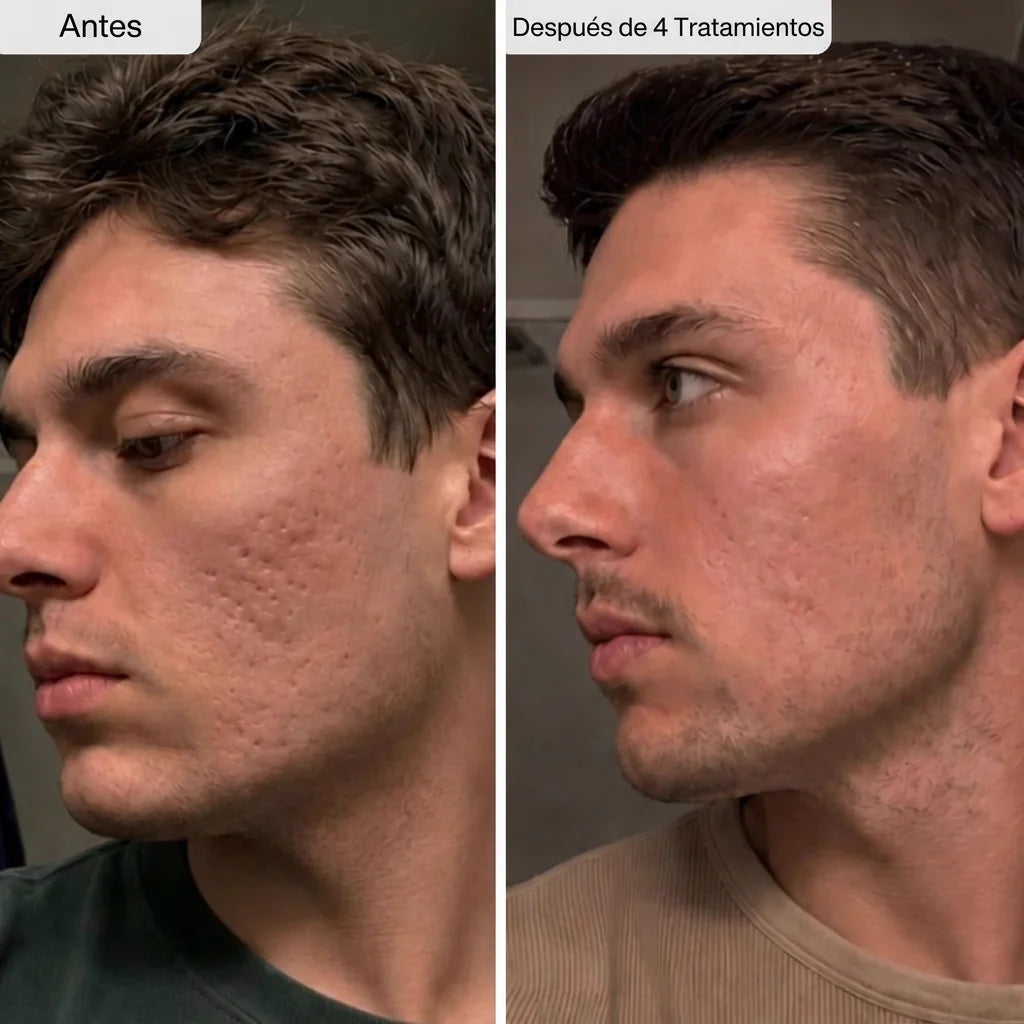 Potenciador de Piel con Micro-Infusión de Péptidos