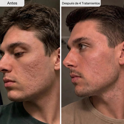 Potenciador de Piel con Micro-Infusión de Péptidos